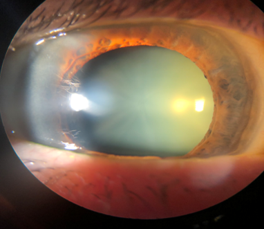 Clinical photograph of a mature cataract