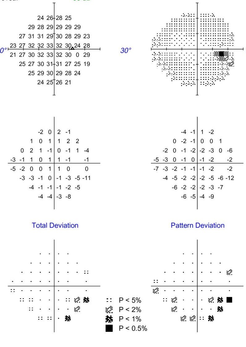 Early visual field loss showing an inferior arcuate defect