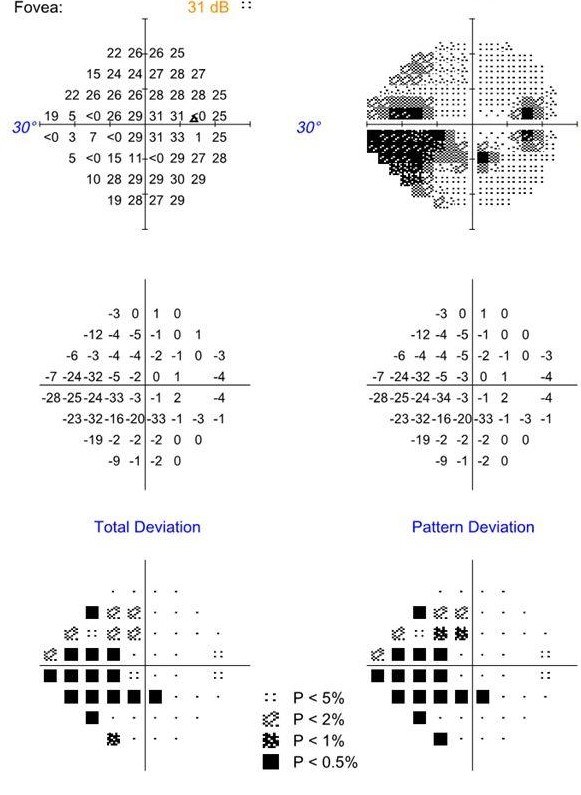 Moderate visual field loss showing a nasal step defect