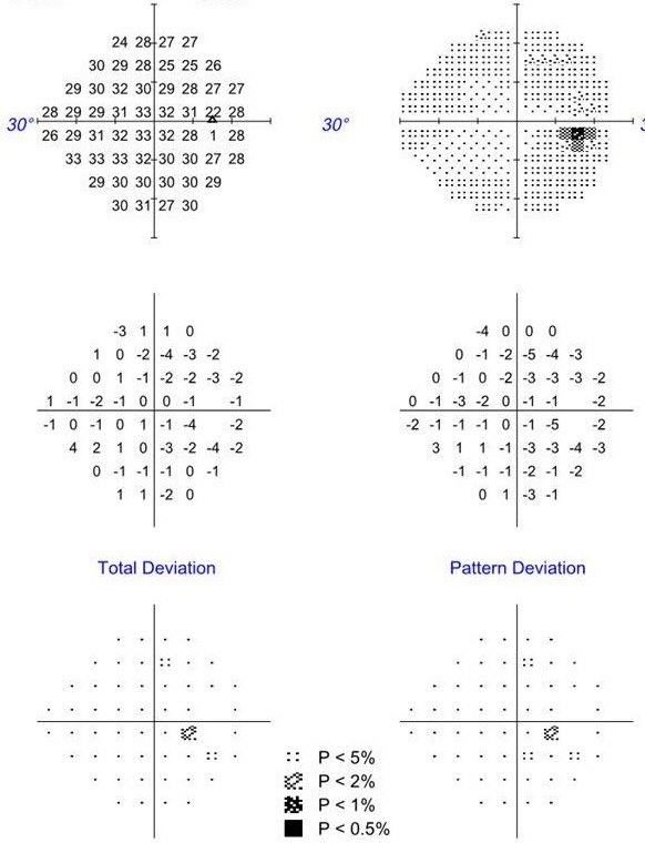 Normal visual field test with no defects