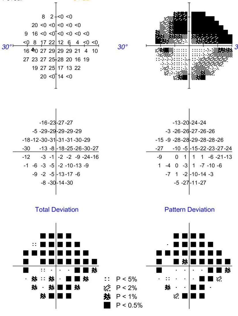 Severe visual field loss with extensive defects