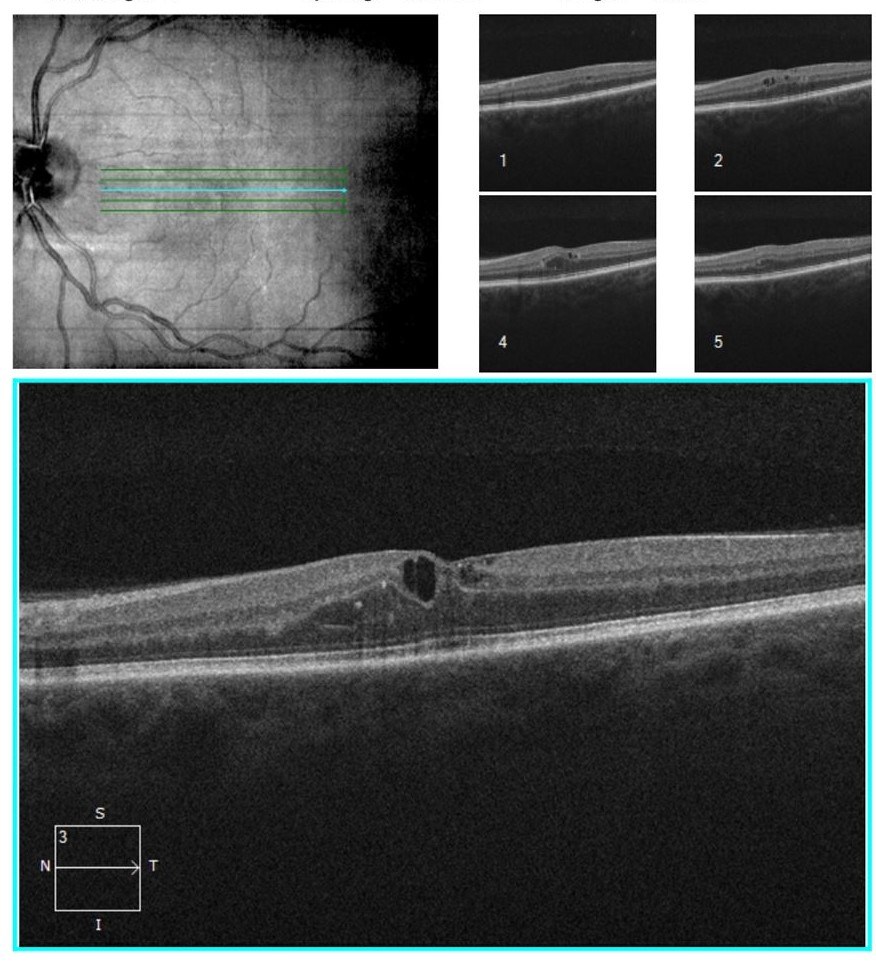 OCT scan showing macular edema with intraretinal fluid