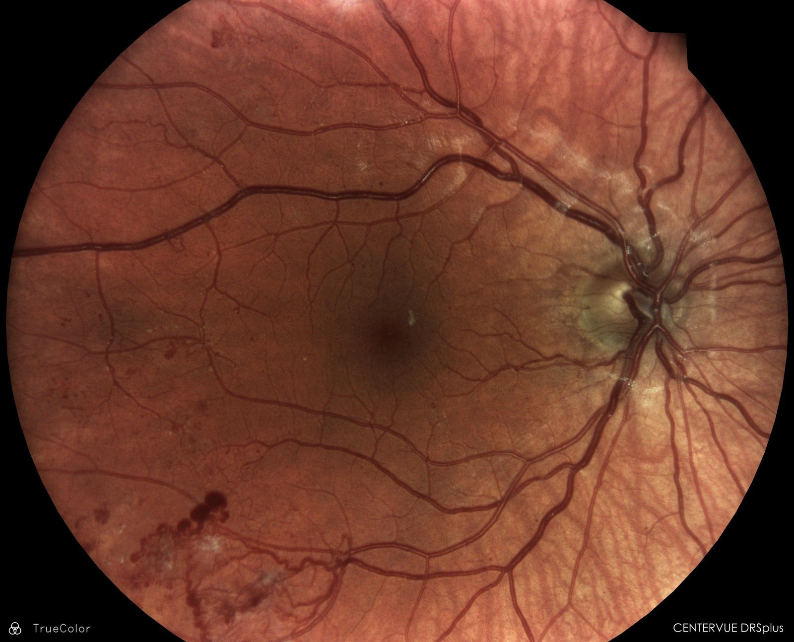Fundus photograph showing neovascularization from diabetic eye disease
