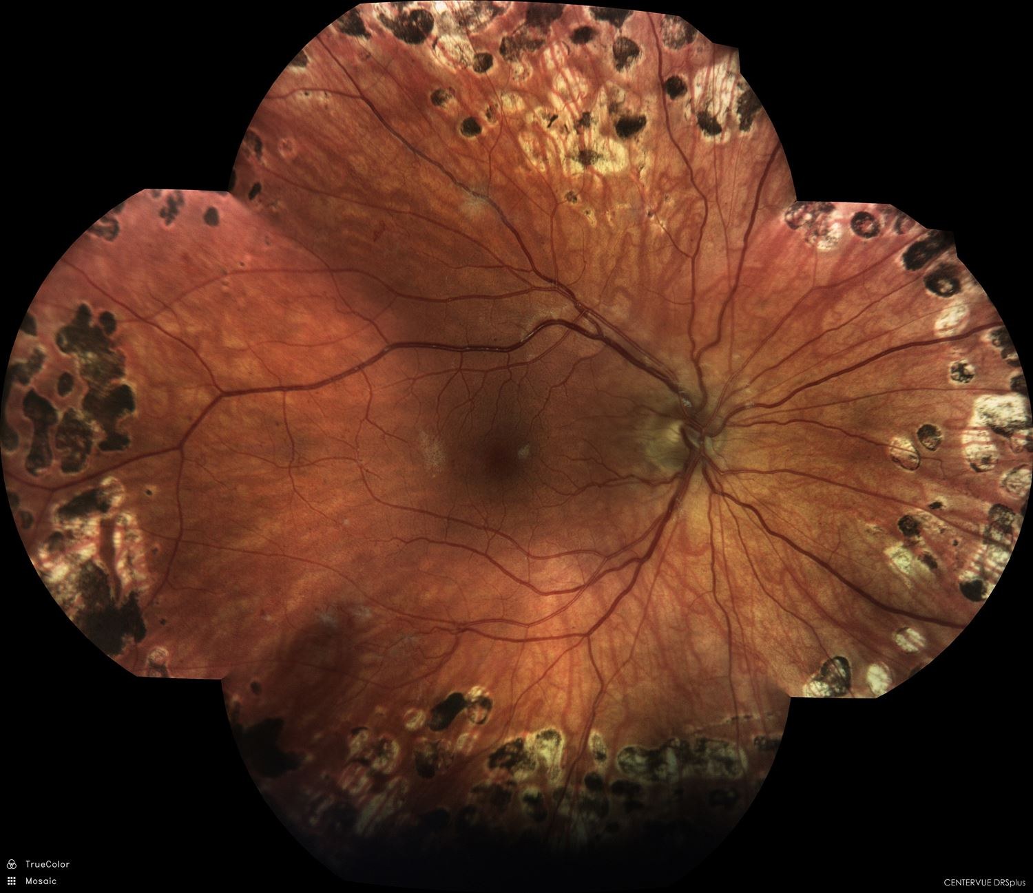 Widefield fundus photo showing regression of neovascularization after PRP laser treatment